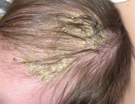 cradle cap in the elderly